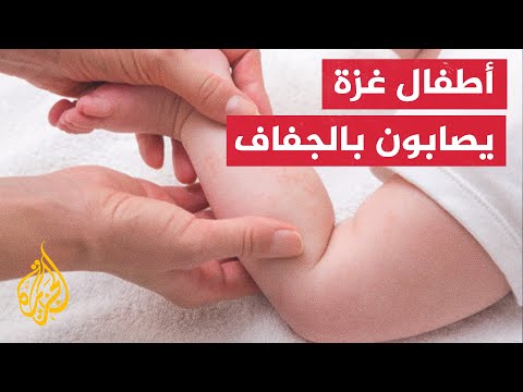 رضيع فلسطيني يعاني من الجفاف الحاد بسبب نقص الغذاء في غزة