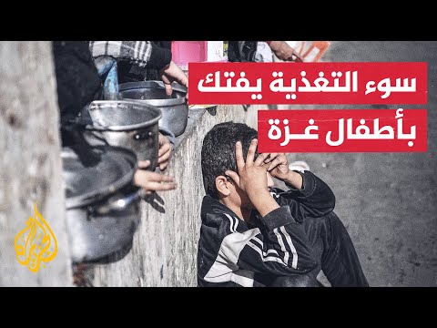 صحة غزة: 60 ألف طفل في القطاع تهددهم مضاعفات صحية خطيرة بسبب سوء التغذية