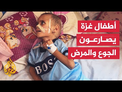 اشتداد معاناة الأطفال في قطاع غزة بسبب سوء التغذية وسط استمرار الحرب الإسرائيلية