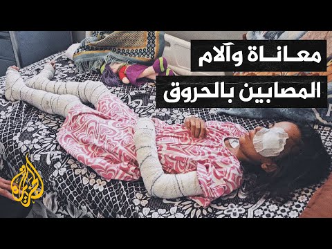 أصوات من غزة| في ظل نقص حاد بالمراهم والمسكنات.. آلام مضاعفة يعانيها المصابون بالحروق