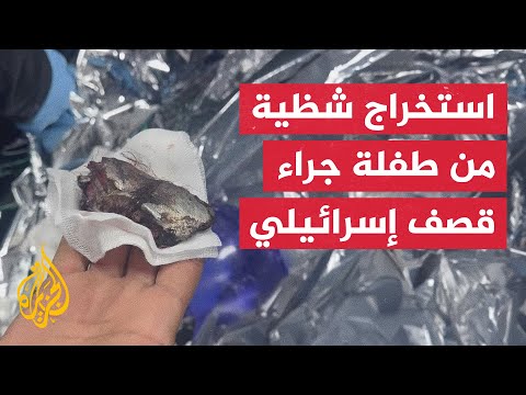 شاهد | استخراج شظية من جسد طفلة بعد إصابتها بقصف إسرائيلي